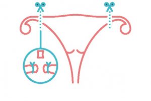 female sterilisation