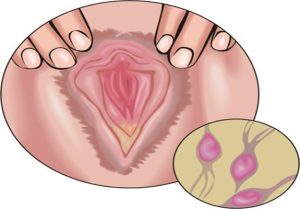 trichomoniasis