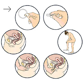 Insertion of the vaginal ring
