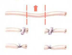 male sterilisation