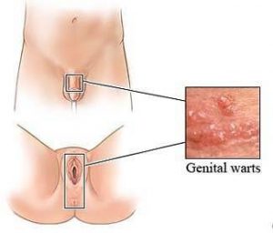 genital warts