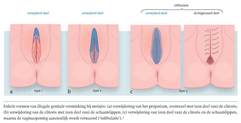 circumcision